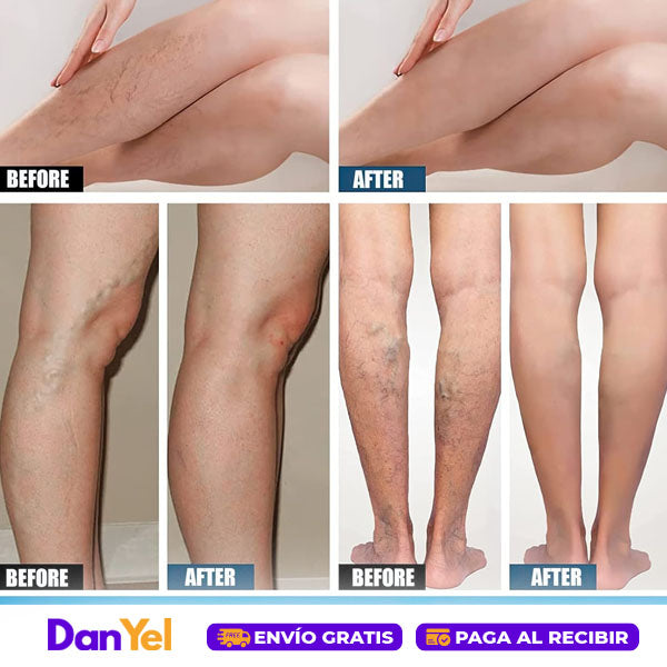 Crema para Aliviar las Varices