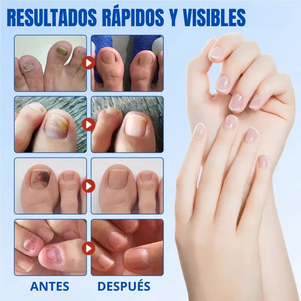 Parches Anti-Hongos para Uñas